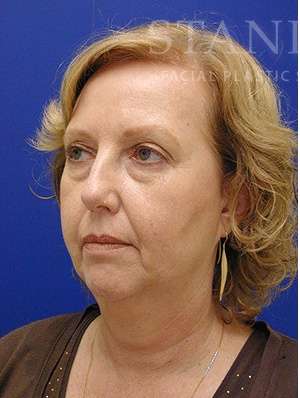 Face/Neck Lift Before & After Patient #576