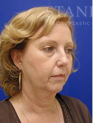 Face/Neck Lift Before & After Patient #576