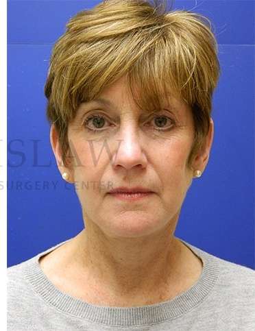 Face/Neck Lift Before & After Patient #565