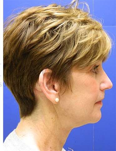 Face/Neck Lift Before & After Patient #565