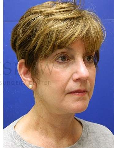 Face/Neck Lift Before & After Patient #565