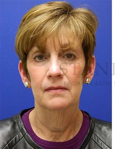 Face/Neck Lift Before & After Patient #565
