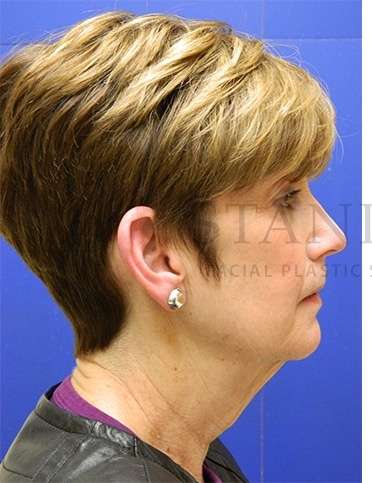 Face/Neck Lift Before & After Patient #565