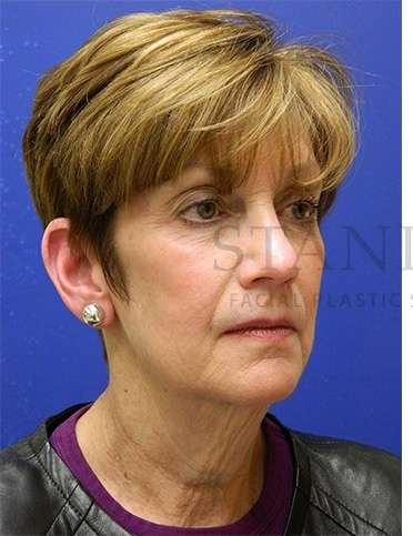 Face/Neck Lift Before & After Patient #565