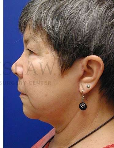 Face/Neck Lift Before & After Patient #558