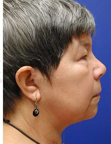 Face/Neck Lift Before & After Patient #558