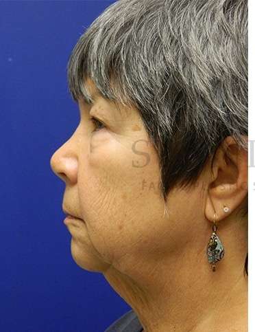Face/Neck Lift Before & After Patient #558