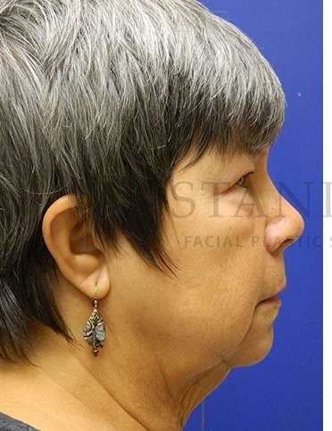 Face/Neck Lift Before & After Patient #558