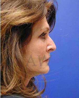 Face/Neck Lift Before & After Patient #542