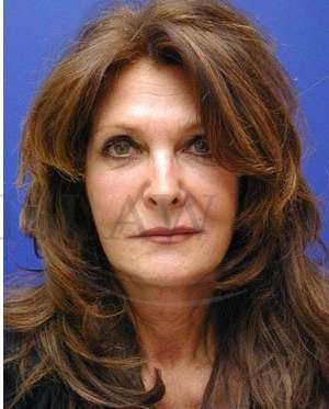 Face/Neck Lift Before & After Patient #542