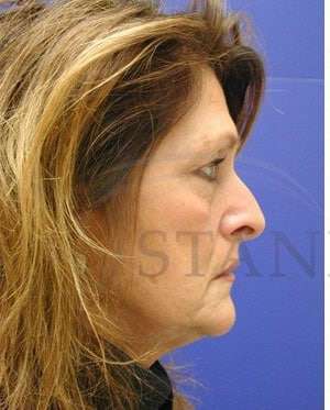 Face/Neck Lift Before & After Patient #542