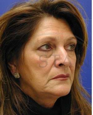Face/Neck Lift Before & After Patient #542