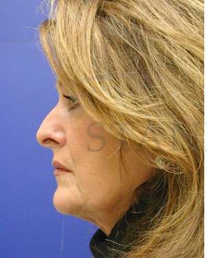 Face/Neck Lift Before & After Patient #542