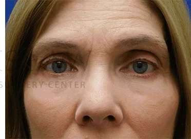 Festoons Before & After Patient #597