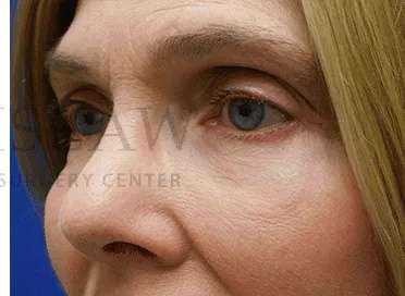 Festoons Before & After Patient #597