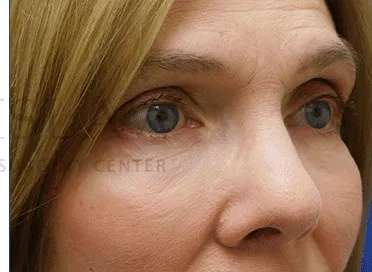 Festoons Before & After Patient #597