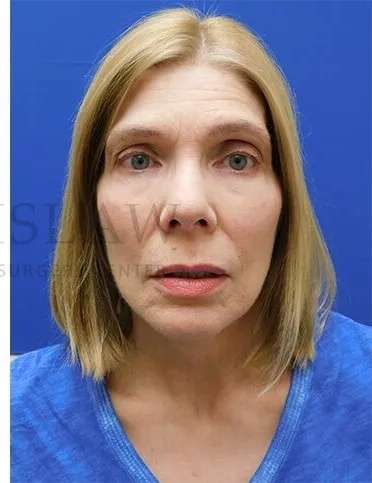 Festoons Before & After Patient #597
