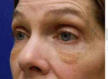 Festoons Before & After Patient #597