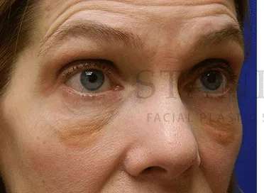 Festoons Before & After Patient #597