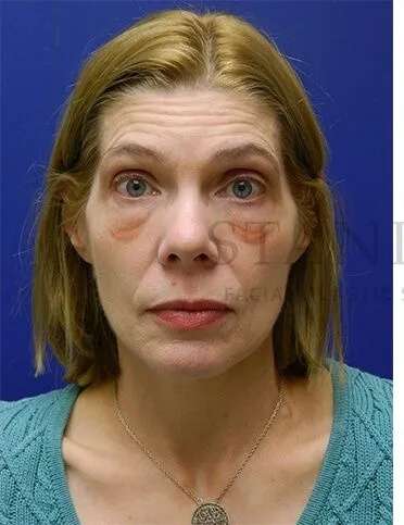 Festoons Before & After Patient #597