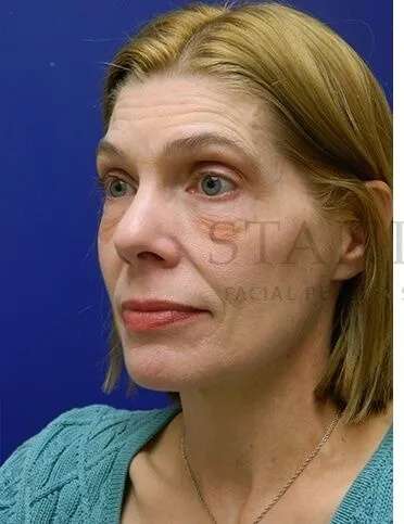 Festoons Before & After Patient #597