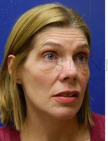 Festoons Before & After Patient #597