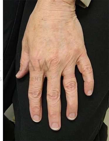 Hand Rejuvenation Before & After Patient #610