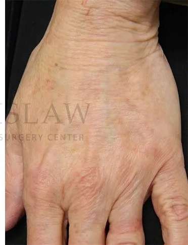 Hand Rejuvenation Before & After Patient #610