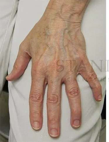 Hand Rejuvenation Before & After Patient #610
