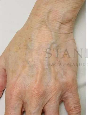 Hand Rejuvenation Before & After Patient #610