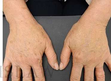 Hand Rejuvenation Before & After Patient #605