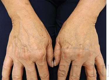 Hand Rejuvenation Before & After Patient #605