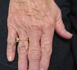 Hand Rejuvenation Before & After Patient #602