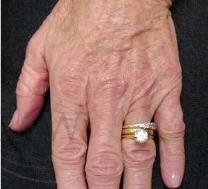Hand Rejuvenation Before & After Patient #602