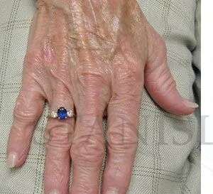 Hand Rejuvenation Before & After Patient #602