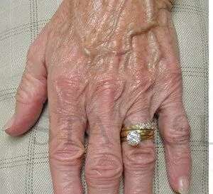 Hand Rejuvenation Before & After Patient #602