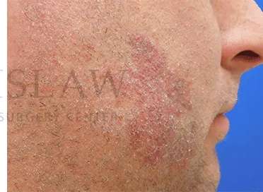 Laser Treatment Before & After Patient #622
