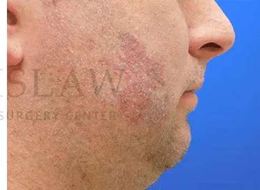 Laser Treatment Before & After Patient #622