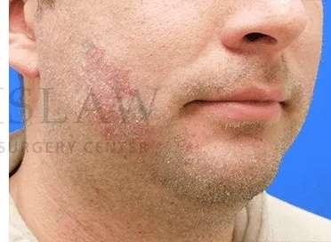 Laser Treatment Before & After Patient #622