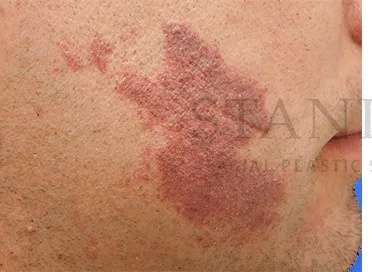 Laser Treatment Before & After Patient #622