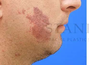 Laser Treatment Before & After Patient #622