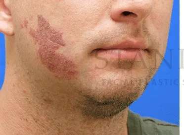 Laser Treatment Before & After Patient #622