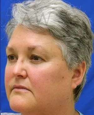 Laser Treatment Before & After Patient #655