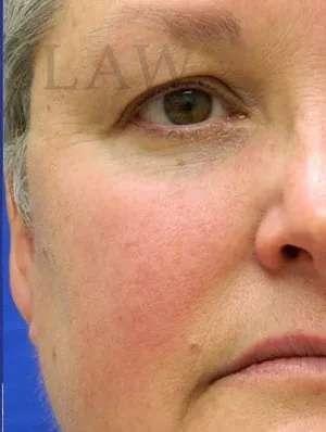 Laser Treatment Before & After Patient #655