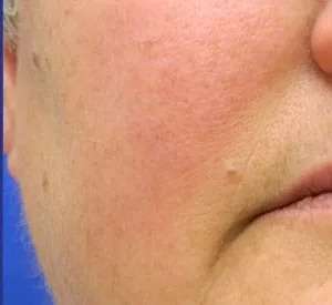 Laser Treatment Before & After Patient #655