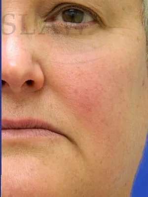 Laser Treatment Before & After Patient #655