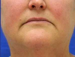 Laser Treatment Before & After Patient #655