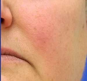 Laser Treatment Before & After Patient #655
