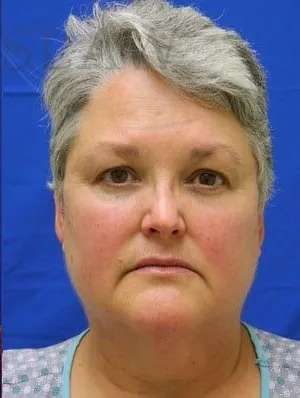 Laser Treatment Before & After Patient #655