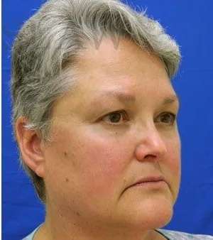 Laser Treatment Before & After Patient #655